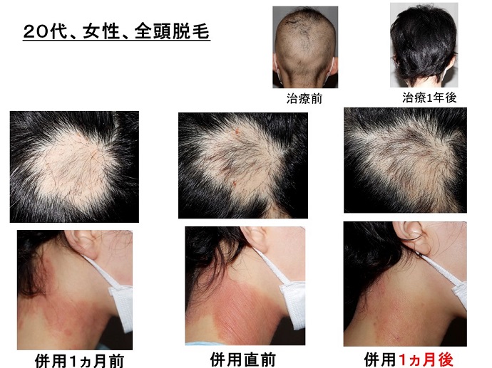 円形脱毛症　病院